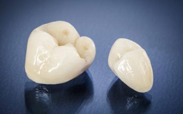 インプラントの仮歯は長期使用に向かない