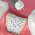 骨がない状態でもインプラント可能？骨を増やす骨造成とは