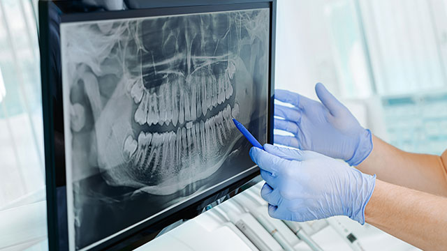 親知らずの抜歯は歯医者・大学病院と何処で行うのが良い？