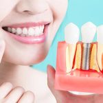 歯を失った際のインプラント治療は痛くて腫れるのが普通なのか？