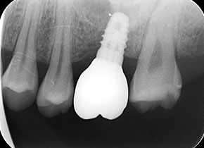 インプラント症例