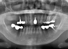 インプラント症例