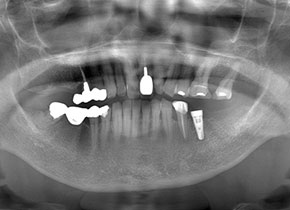 インプラント症例