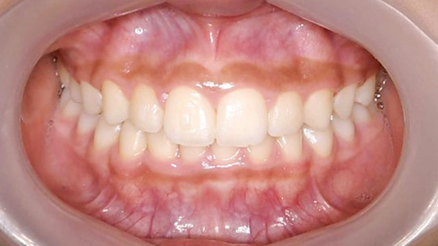 小児矯正で歯のガタガタを改善