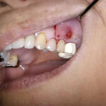 歯根端切除術(根っこの先の膿の除去)の治療例