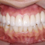 矯正より早く治療が可能なセラミック(ジルコニア)矯正