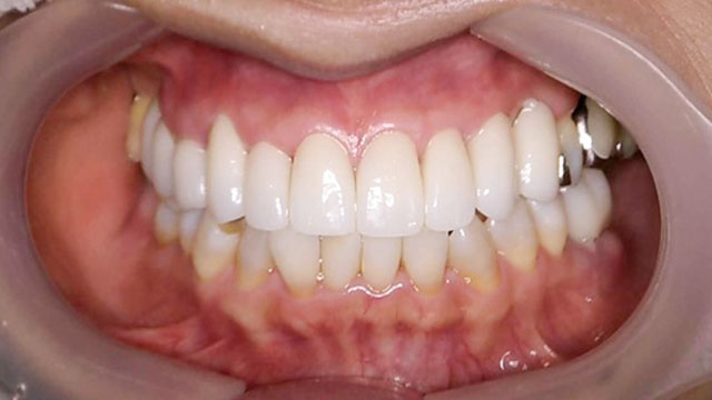 矯正より早く治療が可能なセラミック（ジルコニア）矯正