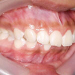 前歯の出っ張りと、下の歯のガタガタを治したい