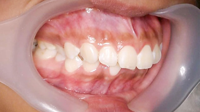 前歯の出っ張りと、下の歯のガタガタを治したい