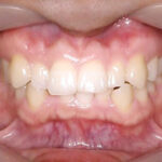 上と下のガタガタを歯を抜かずに治したい