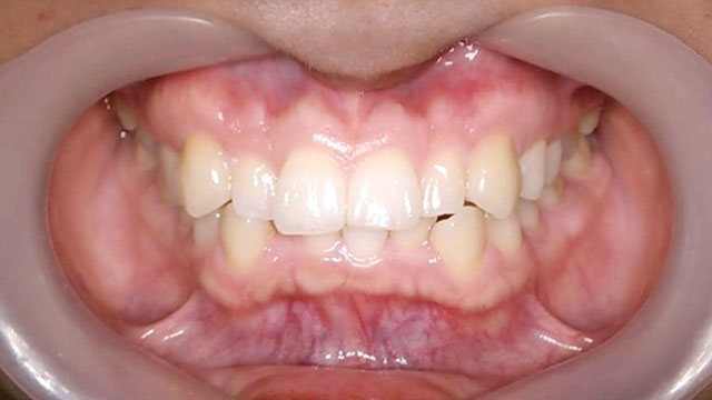 上と下のガタガタを歯を抜かずに治したい